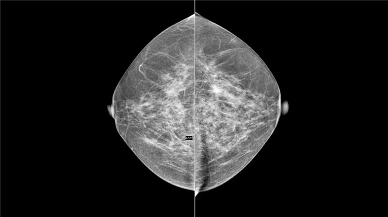 How to prepare for a mammogram